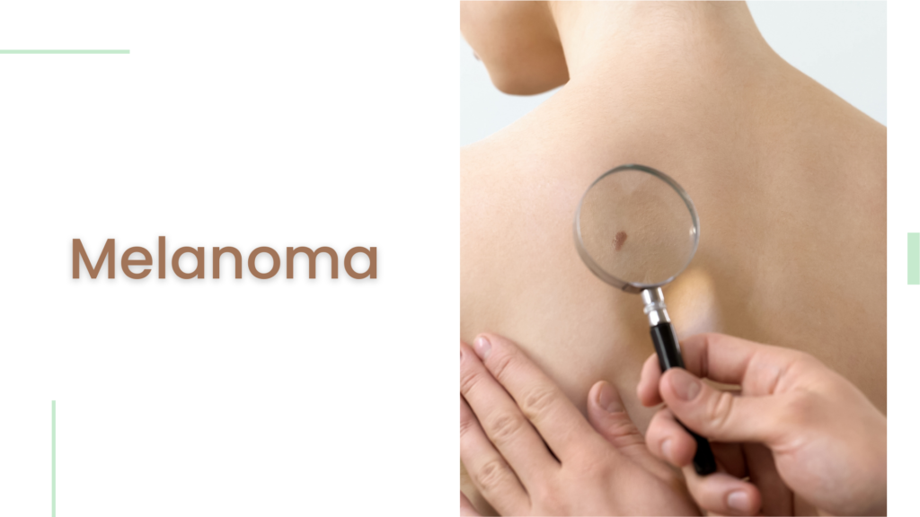 Melanoma